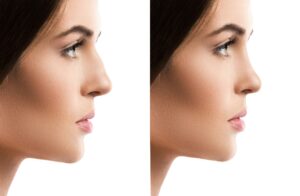 Comparison female face after rhinoplasty on white background
